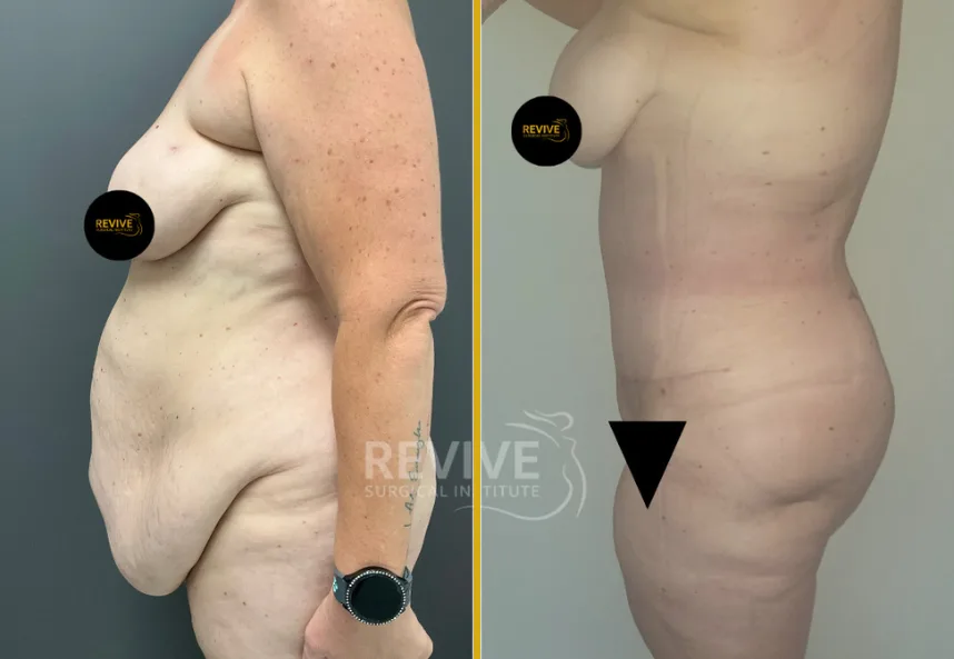 Before and after fleur de lis tummy tuck showing midsection and abdomen tightening from side view