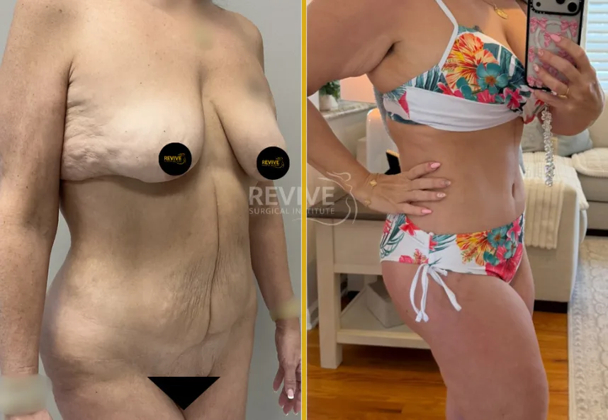 Before and after abdominoplasty: left shows excess abdominal skin and tissue, right shows toned midsection