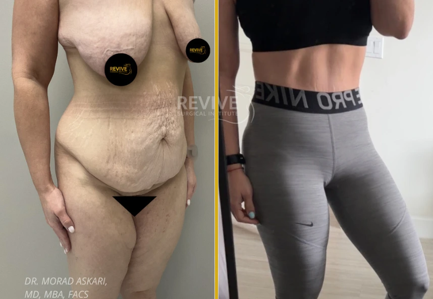 Before and after tummy tuck by Dr. Morad Askari: left displays loose abdominal skin, right shows defined abdomen and waist