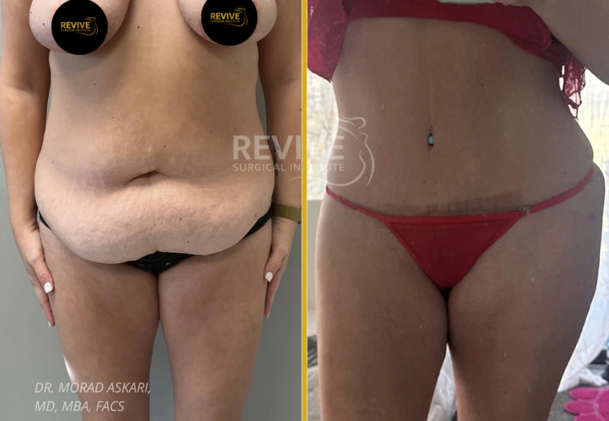 Before and after tummy tuck by Dr. Morad Askari: left shows sagging abdomen, right displays flat stomach with minimal scarring