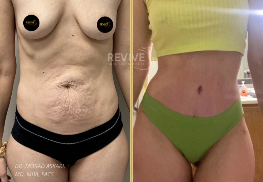 Before and after tummy tuck by Dr. Morad Askari: left shows stretched midsection, right reveals firm, contoured abdomen