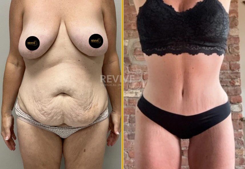 Before and after abdominoplasty: left shows excess skin and breast tissue laxity, right displays sculpted torso with smooth contours