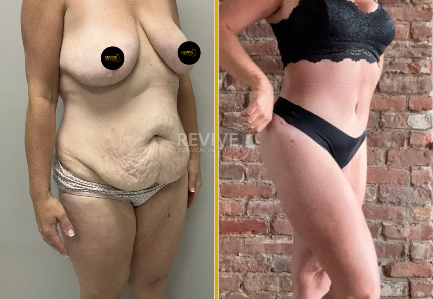 Before and after tummy tuck: left shows loose abdominal skin and tissue, right shows defined, tightened midsection