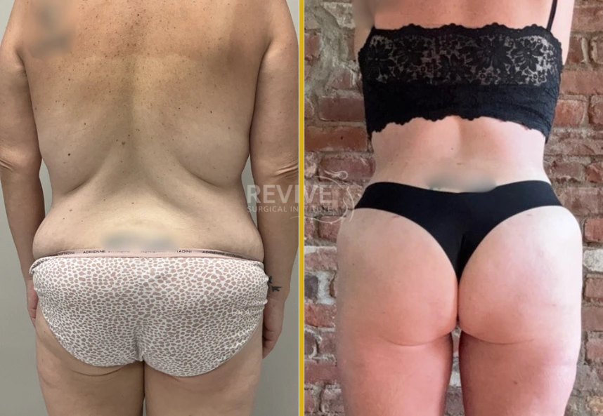 Before and after tummy tuck: rear view showing reduced abdominal laxity and improved contour