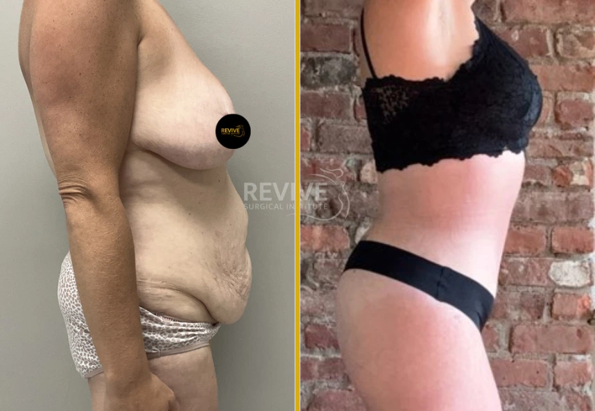 Before and after tummy tuck: side profile showing flattened abdomen and improved body contour