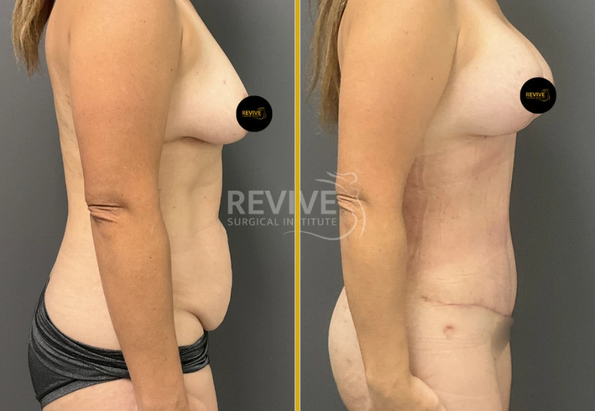 Before and after tummy tuck: side profile showing improved breast contour and abdominal definition