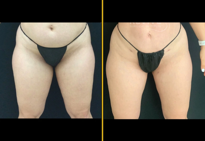 Before and after thigh liposuction showing slimmer, more contoured thighs