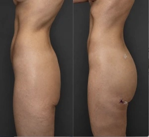 Before and after buttock augmentation with 150 cc Alloclae injections on each side