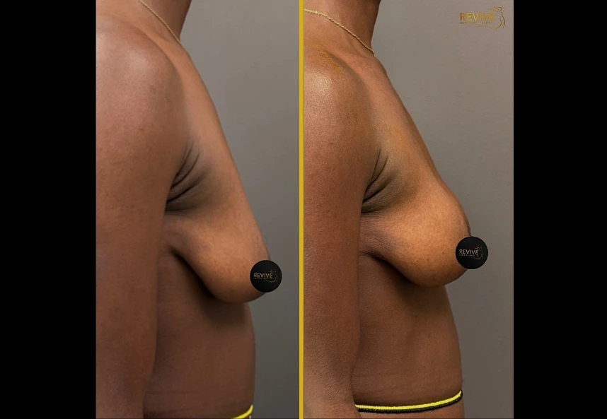 Alloclae before and after in Miami, FL: patient 3, side view, fuller upper breast after 50cc per side