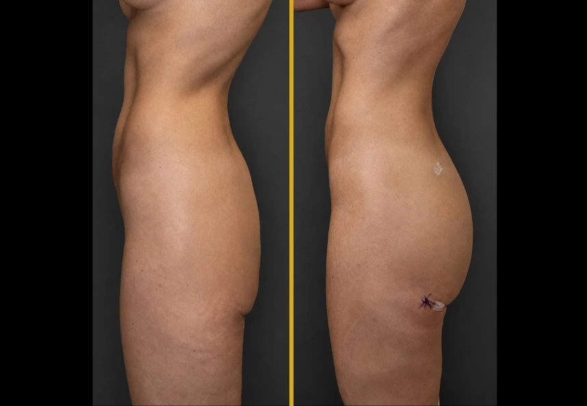 Alloclae before and after in Miami, FL: patient 2, side view, rounder buttock projection after 150cc per side