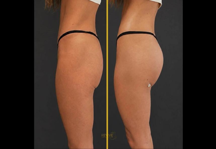 Alloclae before and after in Miami, FL: patient 1, side view, fuller and lifted buttocks after 100cc per side