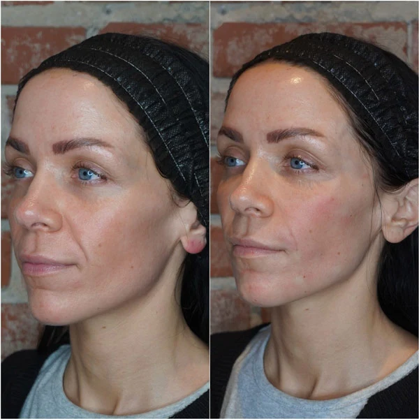 A Rewind Aesthetics client considering EZ Gel Treatment