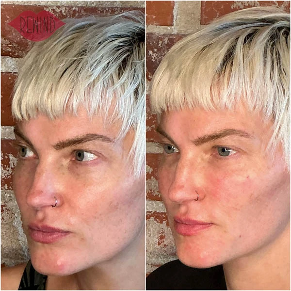 EZ Gel Treatment at Rewind Aesthetics