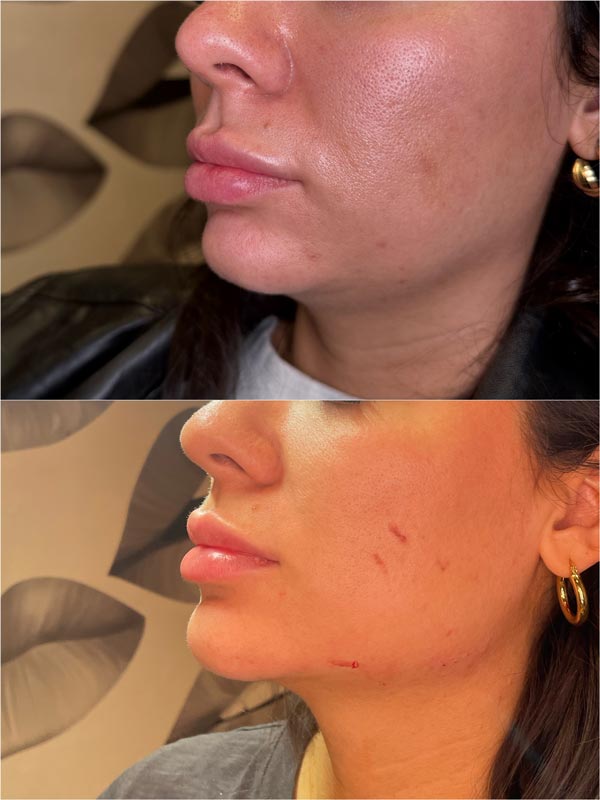 Radiesse at Rewind Aesthetics