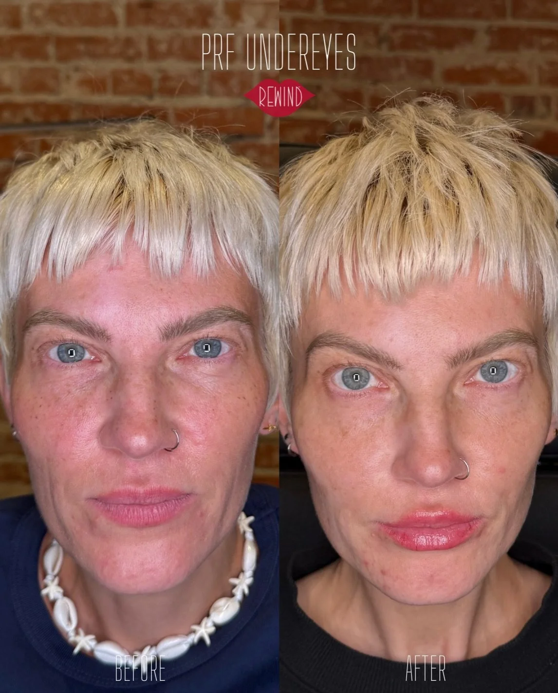 Regenerative Injectables at Rewind Aesthetics