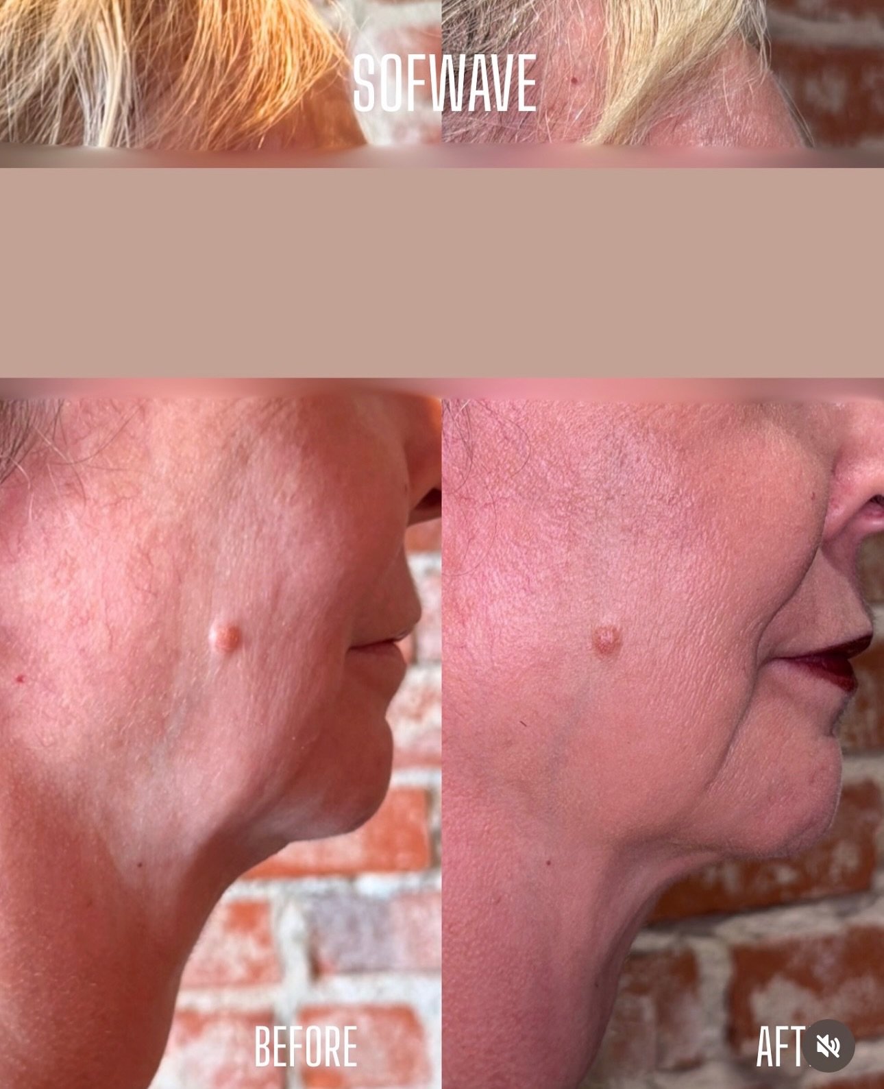 A Rewind Aesthetics client considering Sofwave™