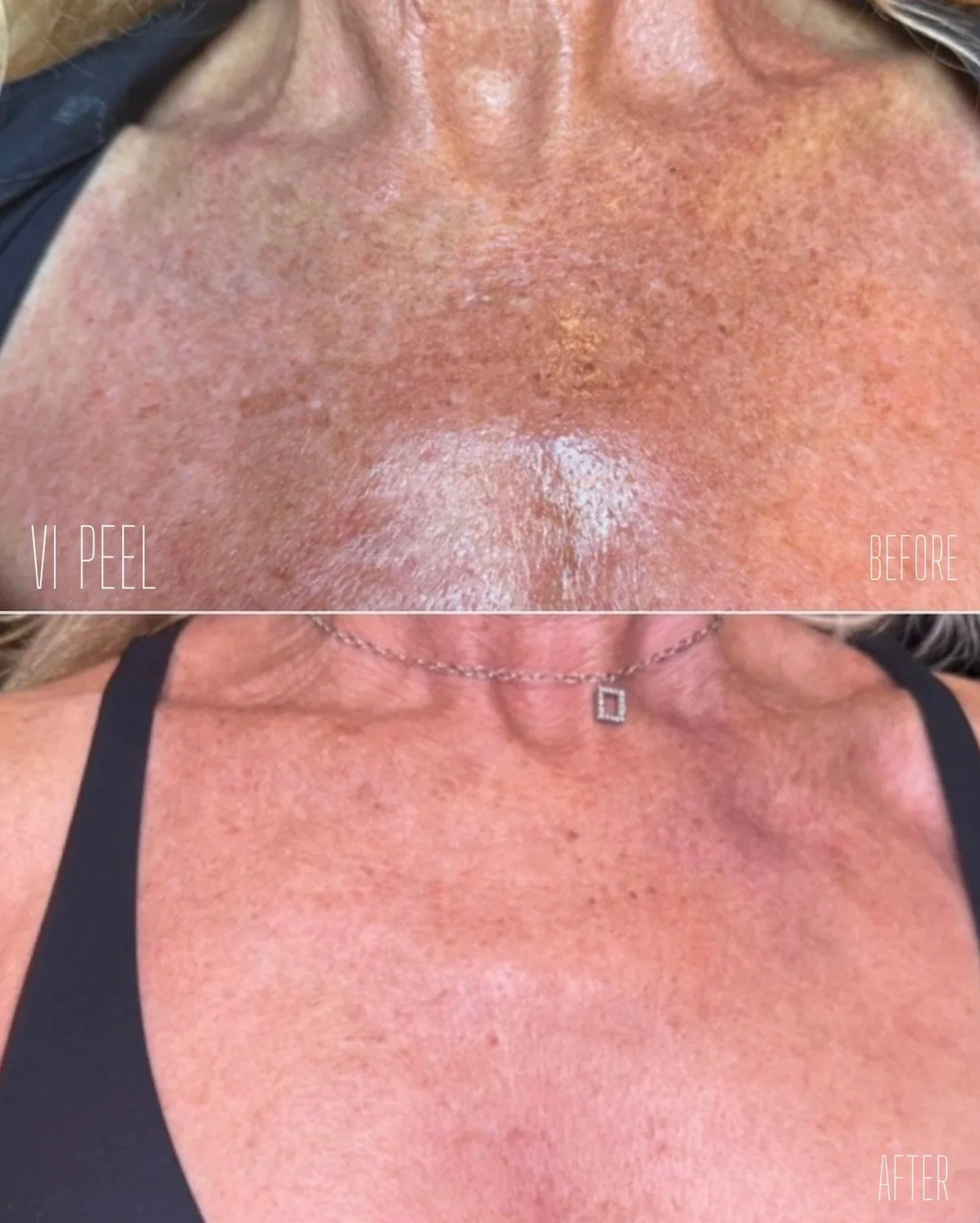 Chemical Peels consultation at Rewind Aesthetics