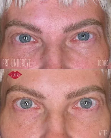 PRF Therapy at Rewind Aesthetics