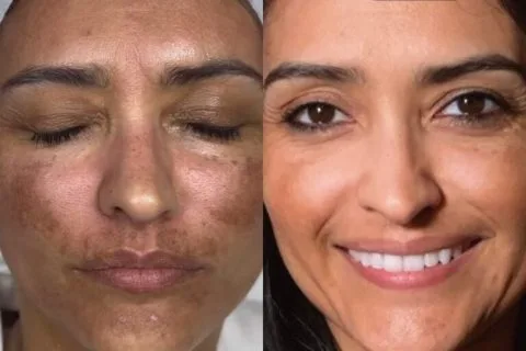 A Rewind Aesthetics client considering Microneedling