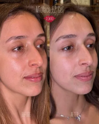 EZ Gel - Case 5 before and after