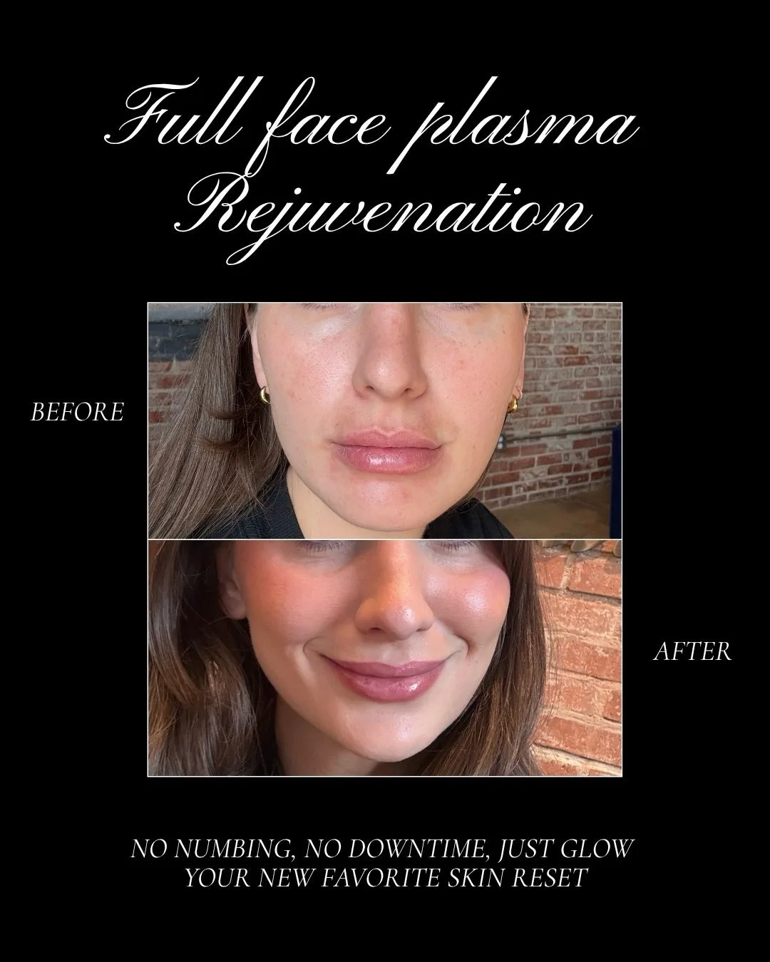 Full Face Plasma Rejuvenation - Case 1 before and after