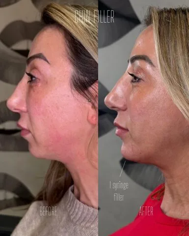 Chin Filler - Case 1 before and after