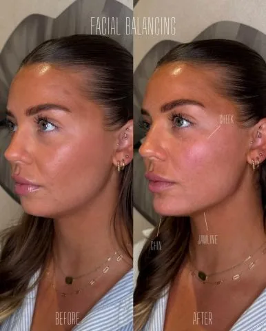 Facial Balancing - Case 3 before and after