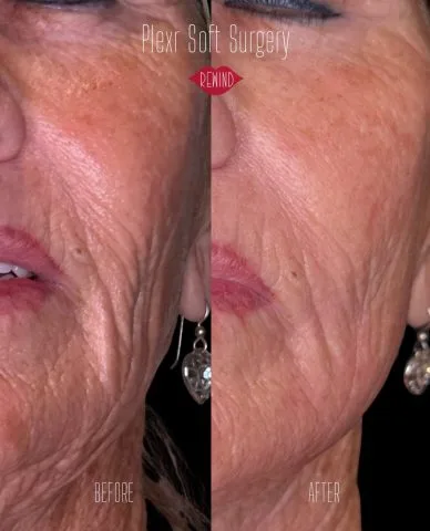PLEXR Soft Surgery - Case 1 before and after at Rewind Aesthetics (3 of 4)