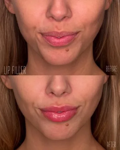 Lip Filler - Case 16 before and after