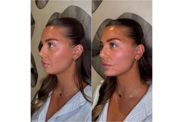 Facial Balancing - Case 1 before and after