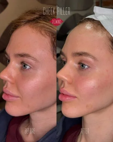 Cheek Filler - Case 1 before and after