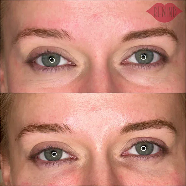 EZ Gel - Case 3 before and after