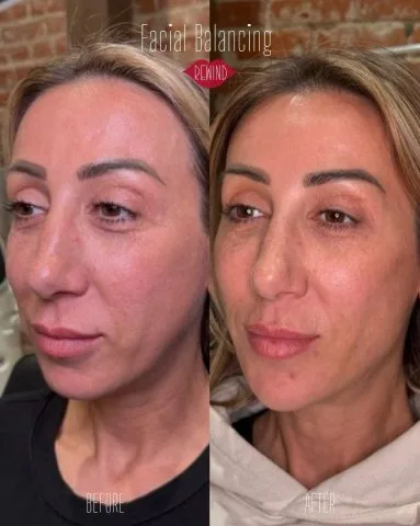 Facial Balancing - Case 2 before and after at Rewind Aesthetics (2 of 2)