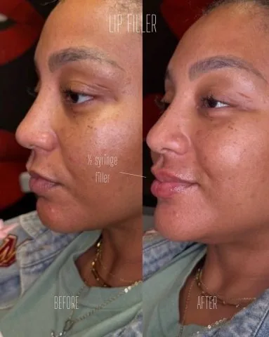 Lip Filler - Case 10 before and after at Rewind Aesthetics (2 of 2)