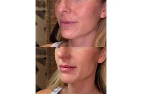 Lip Filler - Case 1 before and after