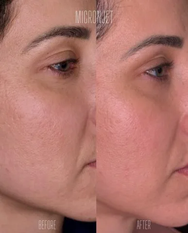 Micronjet - Case 1 before and after at Rewind Aesthetics (2 of 2)