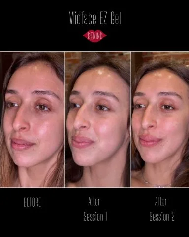 EZ Gel - Case 5 before and after at Rewind Aesthetics (2 of 2)