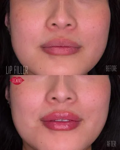 Lip Filler - Case 7 before and after