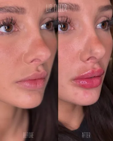 Lip Filler - Case 13 before and after