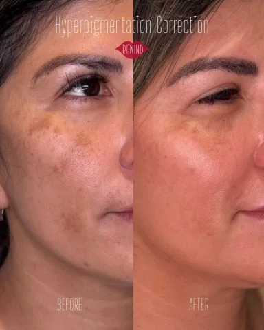 Hyperpigmentation Correction - Case 1 before and after