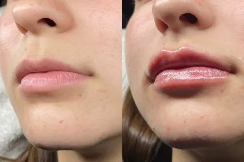 Lip Filler- Case 4 before and after