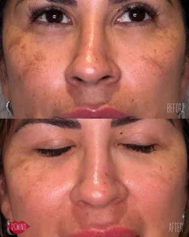 Hyperpigmentation Correction - Case 1 before and after at Rewind Aesthetics (2 of 2)