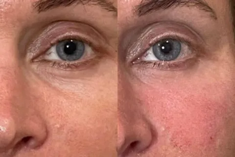 Under-eye Filler - Case 1 before and after