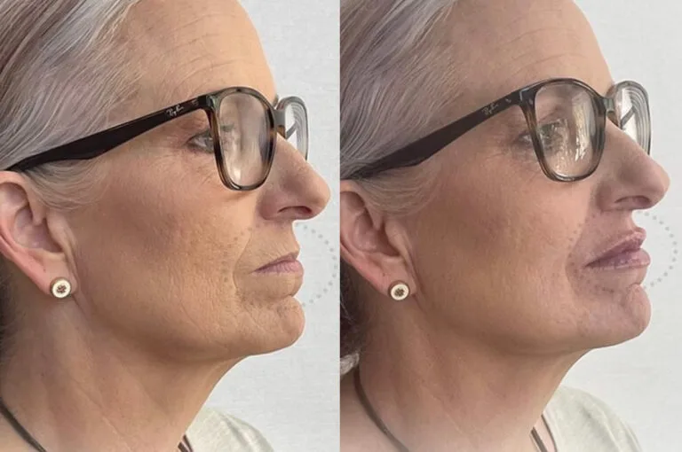 Lip Filler - Case 2 before and after