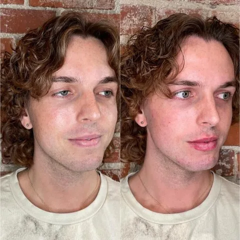 Dermal Fillers - Case 4 before and after