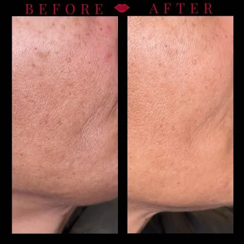 Sculptra - Case 3 before and after