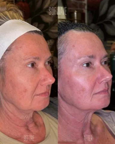 Sofwave - Case 1 before and after