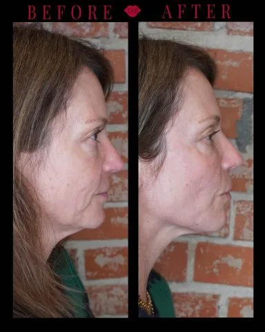 Radiesse - Case 2 before and after at Rewind Aesthetics (5 of 5)
