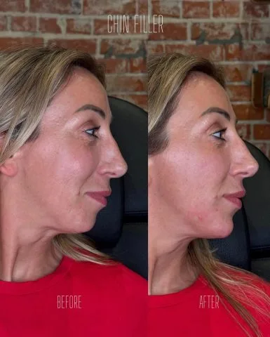 Chin Filler - Case 1 before and after at Rewind Aesthetics (2 of 3)