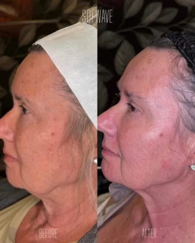 Sofwave - Case 1 before and after at Rewind Aesthetics (2 of 2)
